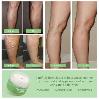 Vein Cream Red Blood Streaks Repair Earthworm Leg Bruises Bulge Relief Pain Safflower Skin care lotion Varicose Cream